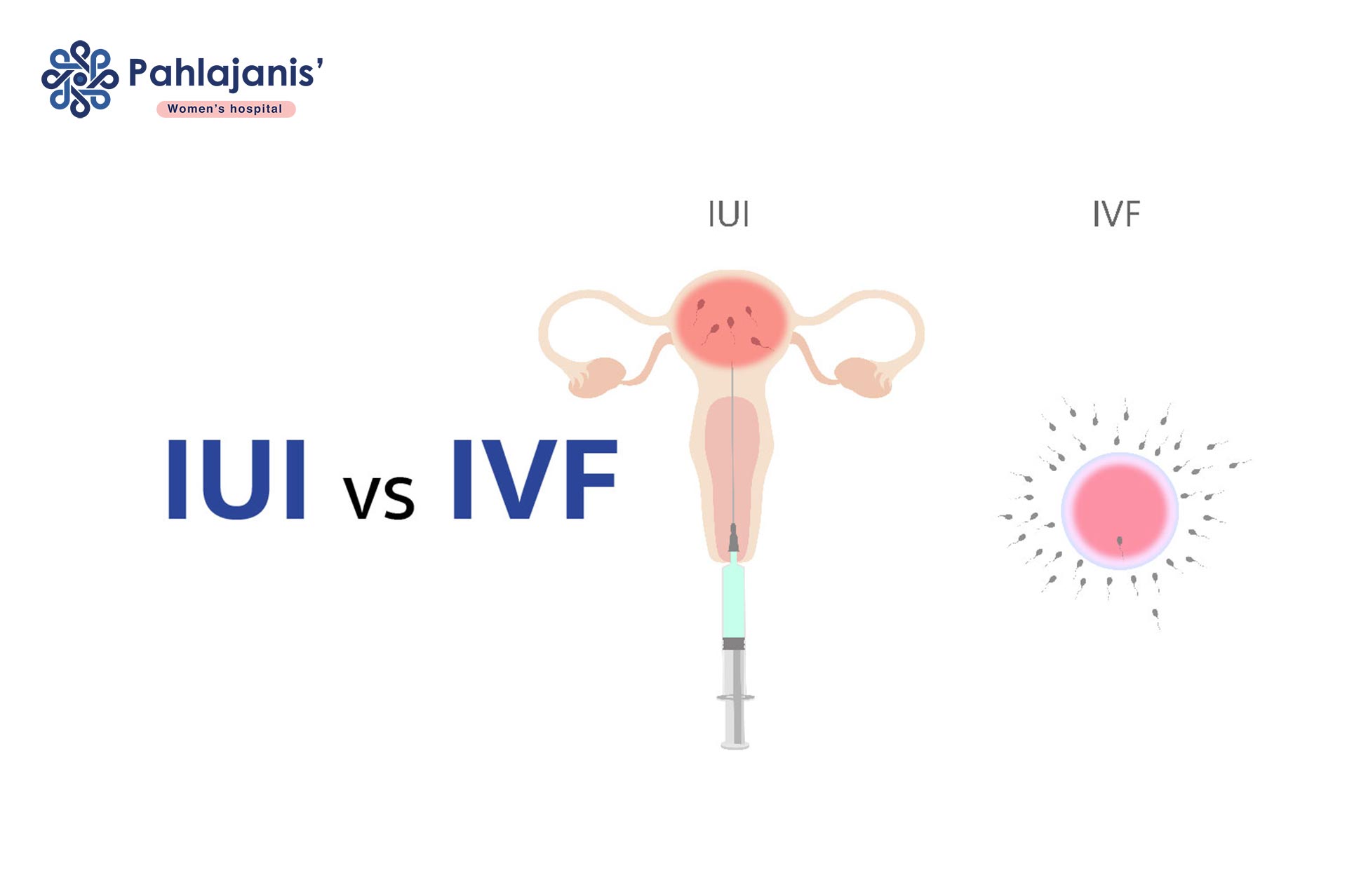 What's The Difference Between IUI And IVF?